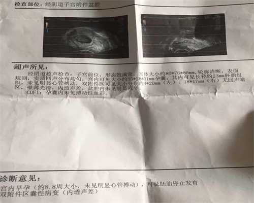 广州世纪助代怀孕双胞胎,宫腔粘连手术费用
