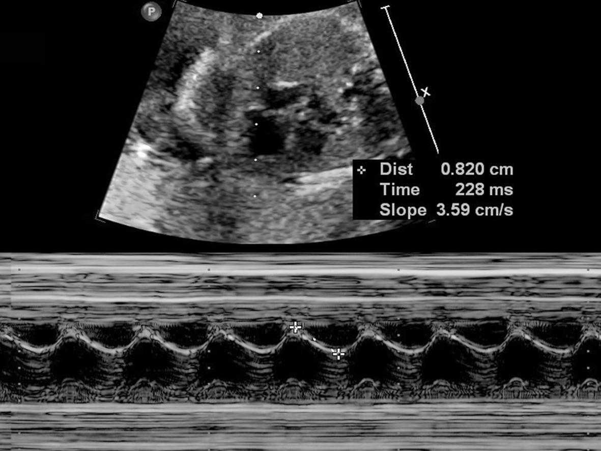 明明白白做超声26-9：超声心动图评估胎儿心功能2