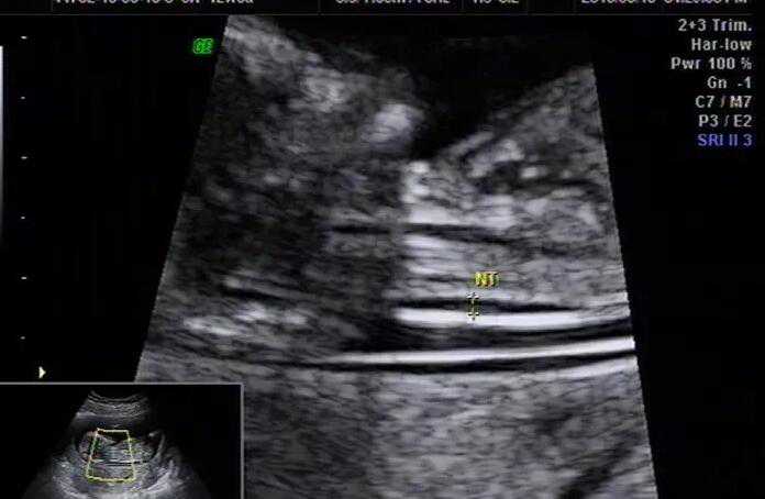 广州去试管代孕经历 广州南方医院可以做供卵试管 ‘男孩b超影像呈现什么三条